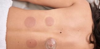 Cupping Is Trending, But Does it Help Recovery?