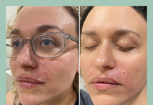 I Tried a Platelet-Rich Plasma Facial for My Postpartum Skin Issues—This Is What Happened