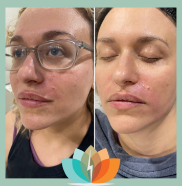 I Tried a Platelet-Rich Plasma Facial for My Postpartum Skin Issues—This Is What Happened